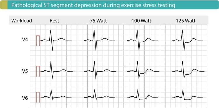 Figur 5. Anstrengelses-EKG hos en patient med koronararteriesygdom viser signifikante ST-sænkninger i J-60-punktet og J-80-punktet. Disse depressioner bliver mere udtalte, når arbejdsbelastningen øges. Denne test blev udført på cykel.