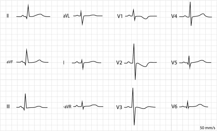 Figur 3. EKG optaget hos en 8 dage gammel pige. Den elektriske akse afviger mod højre (negativ QRS i afledning I og positiv QRS i afledning II). R-bølgerne er fremtrædende i afledning V1, V2 og V3. Der er negative T-bølger i V1–V3, som også er normale. Der er Q-bølger i de inferiore ekstremitetsafledninger (II, aVF og III) og i de laterale brystafledninger (V5, V6).