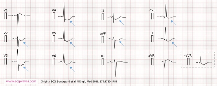 12-lead ECG (presented according to Cabrera), recorded at 63 years of age, demonstrates concave-upward ST-segment depression in leads I, II, aVL, aVF, and V2 through V6; and ST-segment elevation in lead aVR (which corresponds to an identical ST-segment depression in the inverted lead -aVR). A notch is evident in the ascending part of the ST segment.