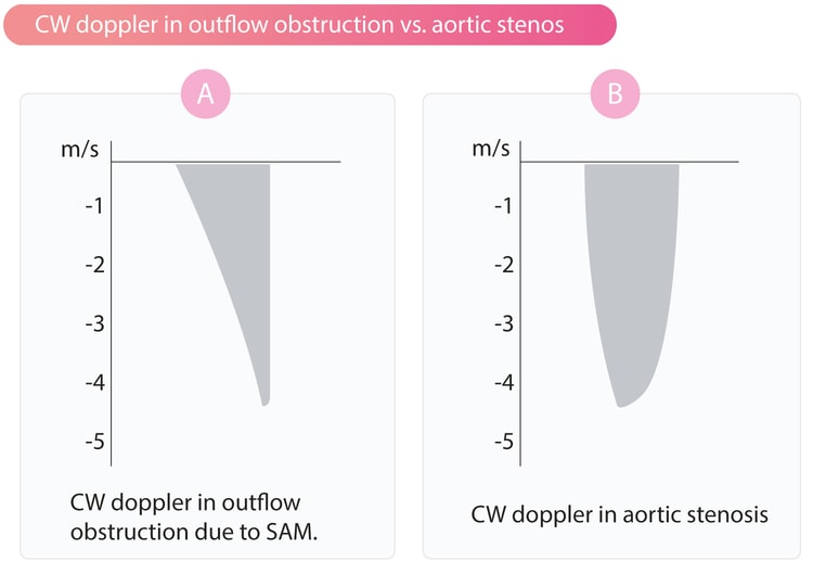 Figur 3. Continuous wave (CW) doppler i LVOT ved (A) obstruktion på grund af SAM og septumhypertrofi og (B) aortastenose.