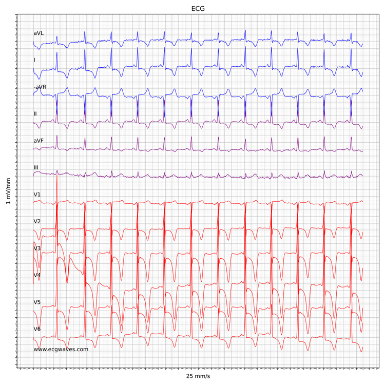 EKG ved hypertrofisk obstruktiv kardiomyopati (HCM, HOCM)
