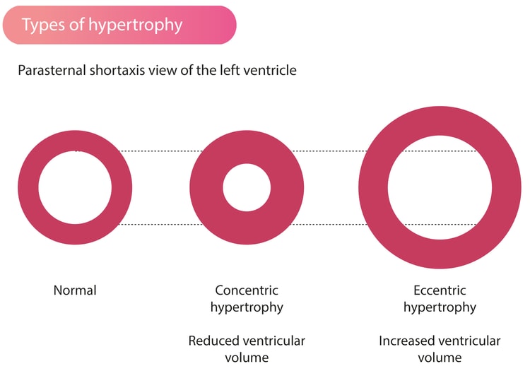 Figur 1. Typer af venstre ventrikelhypertrofi. Venstre ventrikels volumen reduceres ved koncentrisk hypertrofi. Excentrisk hypertrofi resulterer i øget ventrikelvolumen.