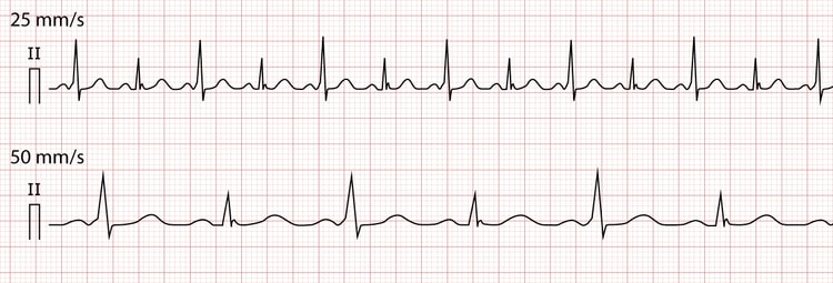 Figur 6. EKG-optagelse, hvor hvert andet slag ledes gennem den accessoriske bane, hvilket resulterer i variationer i QRS-amplituden (elektrisk alternans).