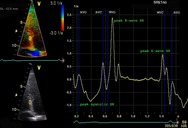 Figur 6. Måling af longitudinal strainhastighed med Doppler. Y-aksen viser strainhastigheden (1/s), og x-aksen viser tiden. Negative værdier observeres under systole (sammentrækning). Kilde