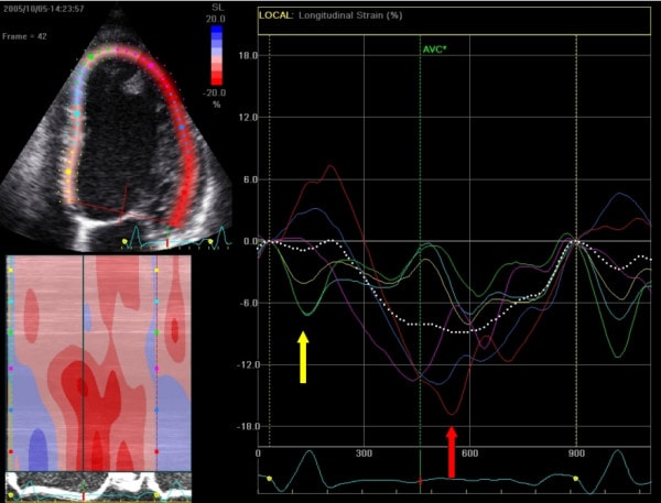 Figur 10. Apikalt firekammerbillede (A4C) med analyse af longitudinel strain. Patienten har hjertesvigt med asynkron aktivering af venstre ventrikel (det ventrikulære myokardium aktiveres ikke synkront). Som det kan ses her, aktiveres de septale dele (gul pil og gulmarkeret myokardium) før de laterale (rød pil og rødmarkeret myokardium). Kilde