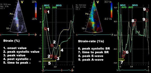 Figur 7. Parametre på strain- og strain rate-diagrammer. Begge paneler viser det samme myokardieområde, dvs. basal septum. Kilde