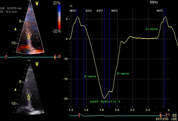 Figur 5. Undersøgelse af strain (longitudinel strain) med vævsdoppler. Septal strain undersøges. Y-aksen viser strain (% deformation), og x-aksen viser tid. Kilde