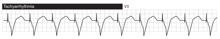 Takyarytmi med ventrikulær pacing.