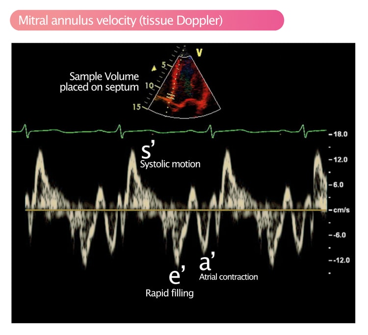 Figur 2. Pulserende vævsdoppler analyserer bevægelser af mitral annulus.