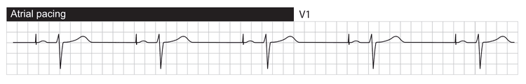 Atriepacing med normal overledning til ventriklerne via AV-systemet. Ventriklerne depolariseres via His-Purkinje-netværket, hvilket resulterer i normal QRS-varighed.