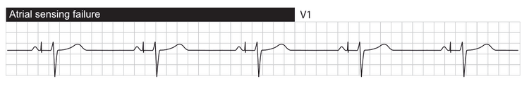 Manglende registrering. Atrial pacing sker efter den intrinsiske P-bølge.