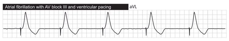 Atrieflimren med tredjegrads AV-blok og ventrikulær pacing.