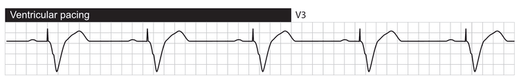 Spontan atrieaktivitet registreres af atrieafledningen og udløser ventrikulær stimulering. QRS-komplekset er bredt, fordi ventriklernes depolarisering helt eller delvist foregår uden for ledningssystemet.