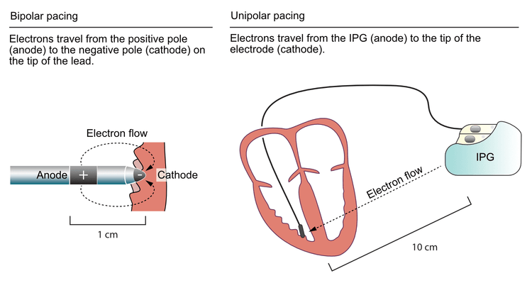 Figur 3. Unipolær vs. bipolær pacing.