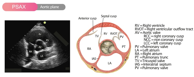 Figur 7. Parasternal kortaksevisning (PSAX) i aortaplanet.