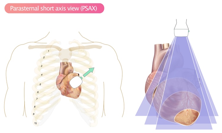 Figur 6. Parasternal kort-akse visning (PSAX).