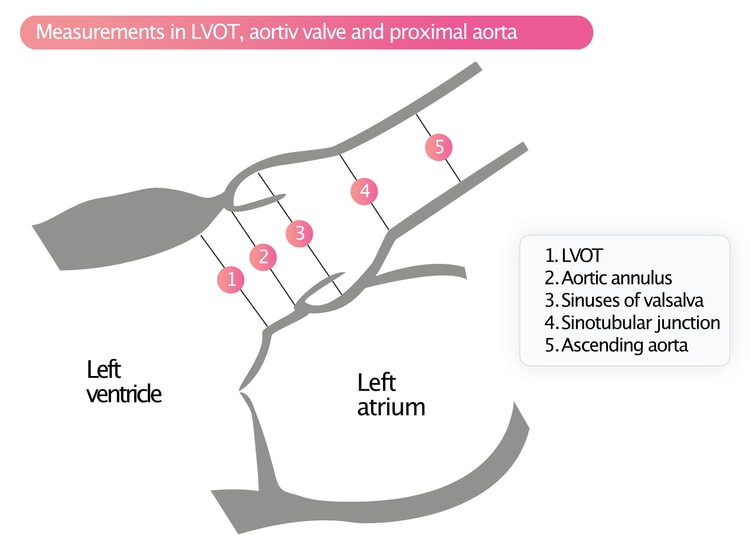 Figur 5. Målinger i LVOT, aortaklappen og den proksimale aorta.