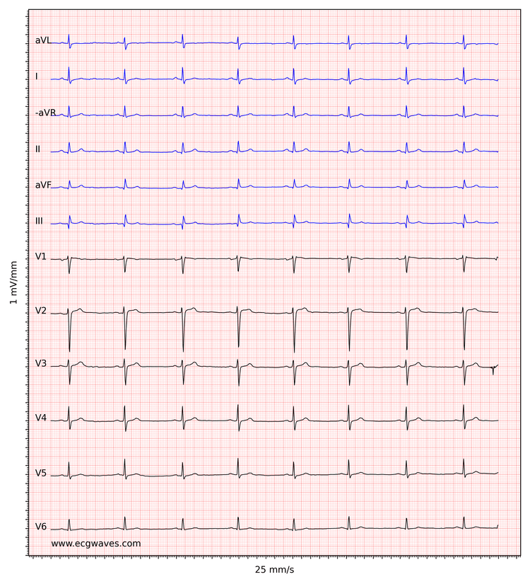 Figur 3. Sinus bradykardi. De små q-bølger i inferiore afledninger (II, aVF, III) er ikke signifikante. Lav spænding i ekstremitetsafledninger.