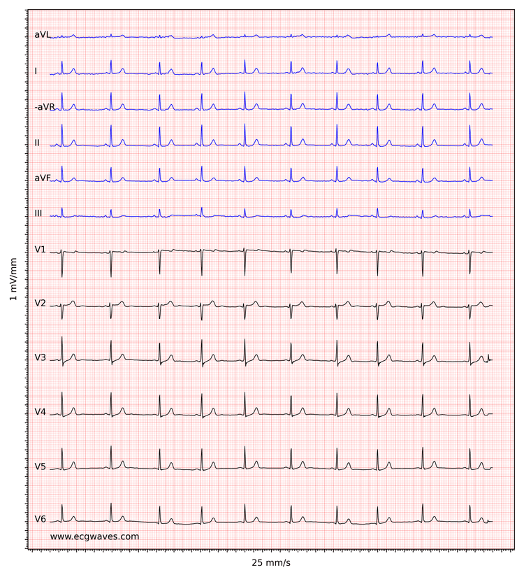 EKG-eksempel 3. Normal sinusrytme.