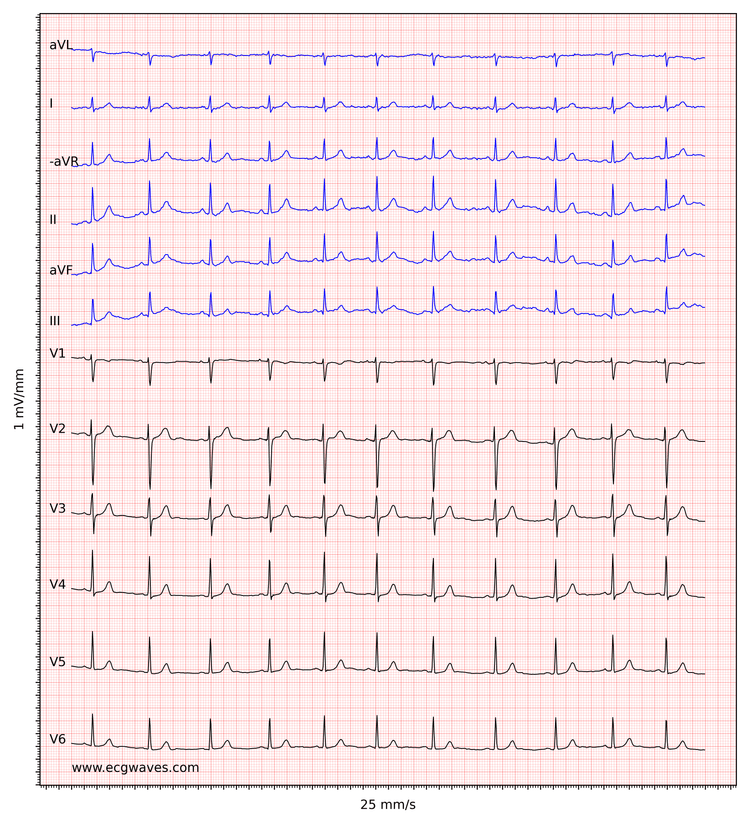 EKG-eksempel 4. Normal sinusrytme.