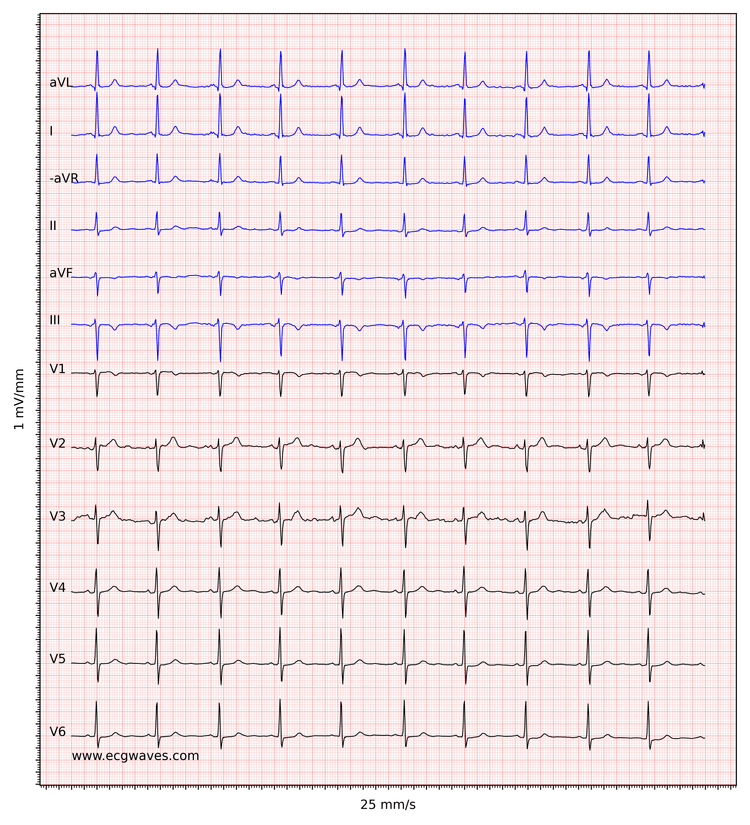 EKG-eksempel 5. Sinusrytme. Negative T-bølger i afledning aVF og III. Diskrete ST-segment-sænkninger i afledning V5-V6.