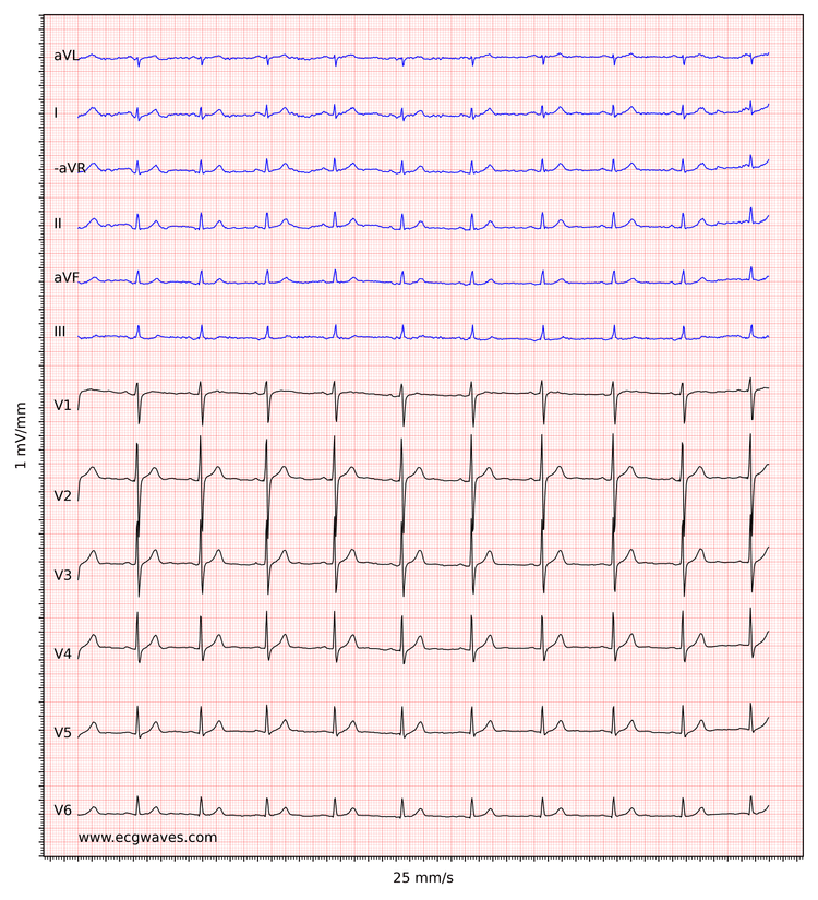 EKG-eksempel 6. Sinusrytme, hurtig progression af R-bølger i prækordiale afledninger. Let ST-segmentforhøjelse i afledning V2-V3, hvilket er normalt hos mænd og kvinder.
