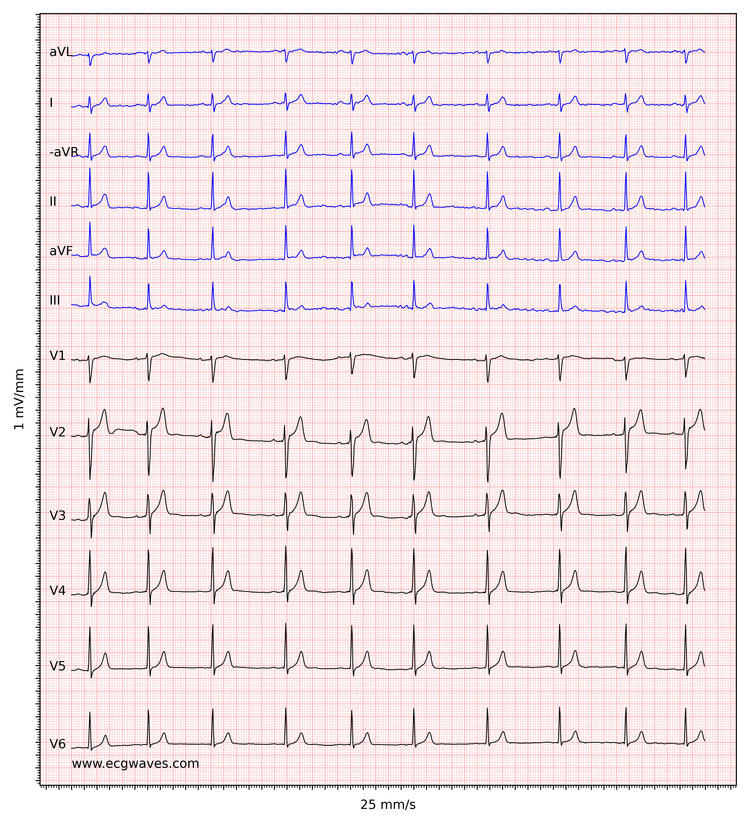 EKG-eksempel 7. Sinusrytme. Relativt store T-bølger i V2-V3 med ST-segmentforhøjelser. I forhold til R-bølgerne er T-bølgerne for store og spidse (differentialdiagnoser overvejes nedenfor).