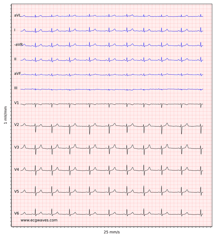 EKG-eksempel 2. Normal sinusrytme. R-bølger har lav amplitude, hvilket tyder på lav spænding (se nedenfor).