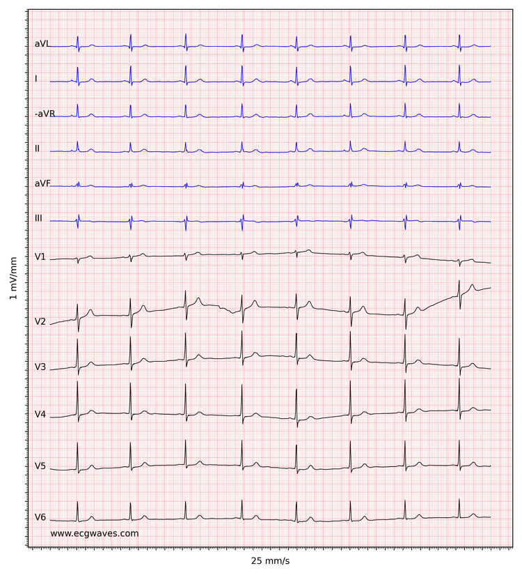 Figur 4. Sinus bradykardi.