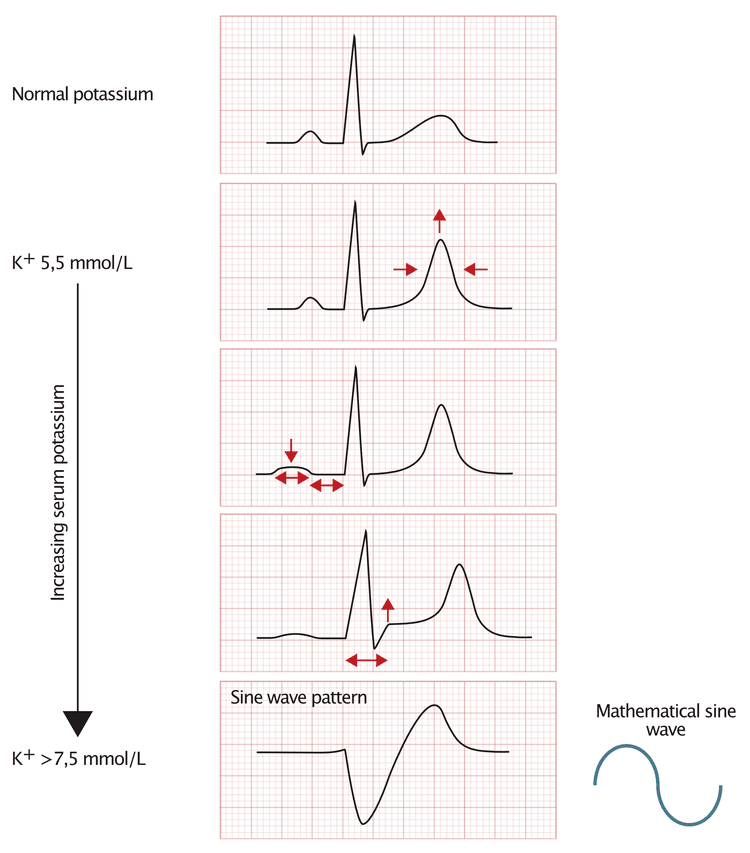 Figur 1. EKG-ændringer set ved hyperkaliæmi.