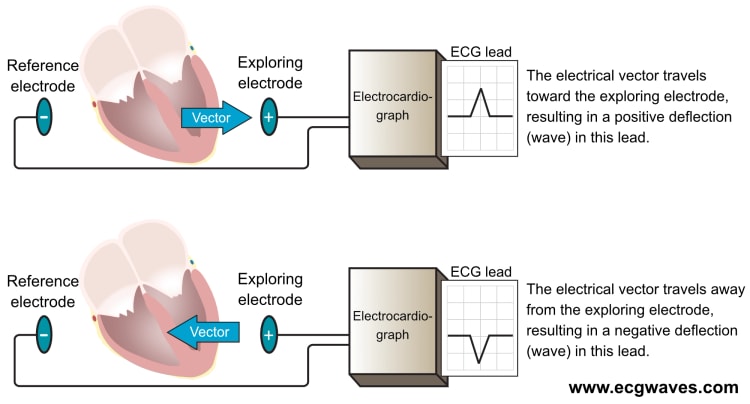 Figur 16. Elektrokardiografen genererer en EKG-afledning ved at sammenligne den elektriske potentialeforskel i to punkter i rummet. I de simpleste afledninger er disse to punkter to elektroder (illustreret i denne figur). Den ene elektrode fungerer som den udforskende elektrode (positiv) og den anden som referenceelektrode. Elektrokardiografen er konstrueret således, at en elektrisk strøm, der bevæger sig mod den undersøgende elektrode, giver en positiv afbøjning og vice versa.