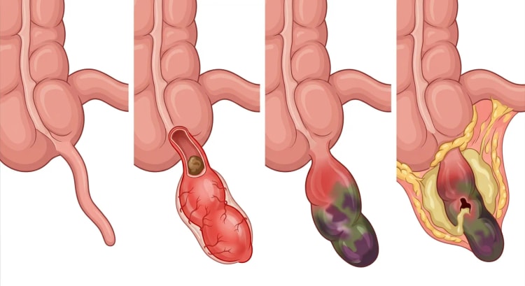 Fire billeder af caecum med appendix: normal, inflammeret med fækalit, gangrænøs og perforeret med absces omgivet af omentum.
