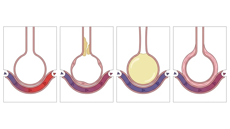 Fire skematiske alveoler med kapillærer: normal, slimblokeret luftvej, væskefyldt alveole og fortykket alveolevæg, med blodets farve fra blå til rød eller uændret.