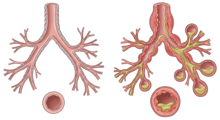 Normalt forgrenet bronkietræ ved siden af et bronkietræ med bronkiektasier, med tværsnit af begge.