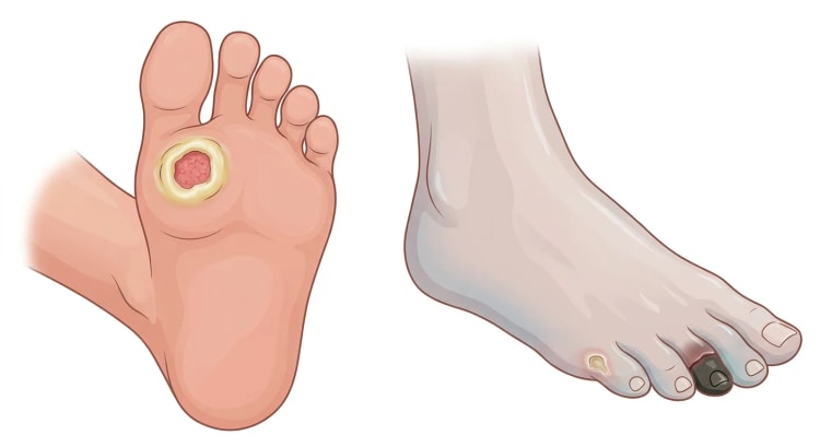 Fodsål med rundt sår under første metatarsalhoved omgivet af callus, ved siden af en bleg iskæmisk fod med sort tør gangræn på anden tå og et lille sår på femte tå.
