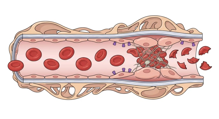 Gennemskåret glomerulær kapillær, hvor rask endotelvæg og intakte erytrocytter går over i hævet, beskadiget endotel med bundet toksin, en trombocyt- og fibrinrig mikrotrombe og fragmenterede erytrocytter nedstrøms.