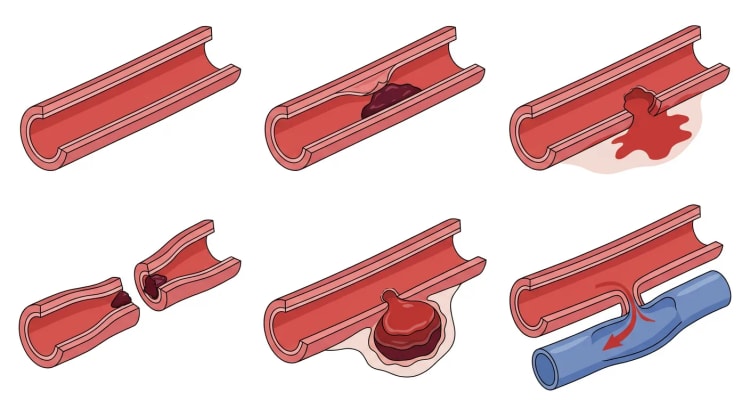 Seks gennemskårne arteriesegmenter, der viser normal arterie og fem typer traumatisk arterieskade.