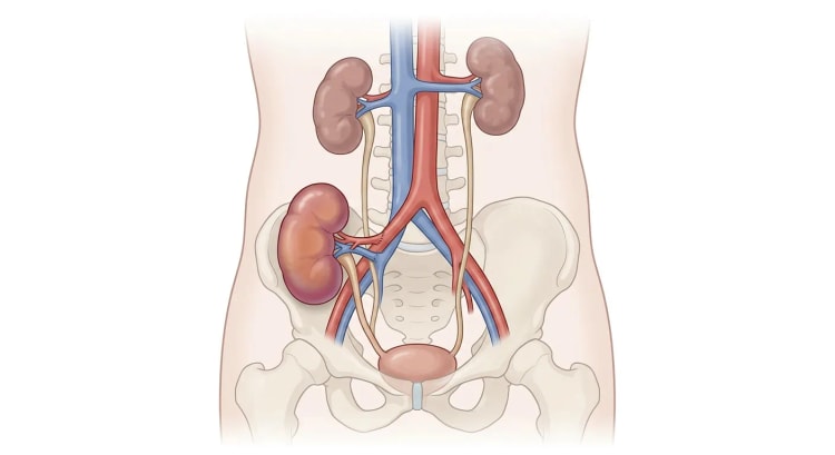 Abdomen og bækken forfra med to egne nyrer på normal plads og en transplanteret nyre i højre fossa iliaca, forbundet til bækkenkarrene og urinblæren.