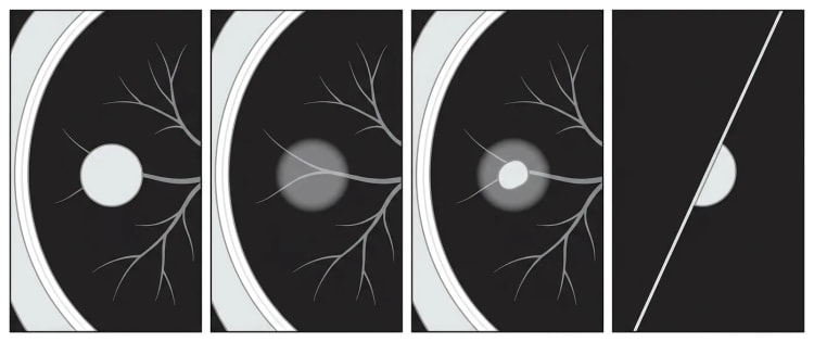 Fire skematiske CT-udsnit af lunge i lungevindue: solid nodulus, ren ground glass-nodulus, delvist solid nodulus og perifissural nodulus.