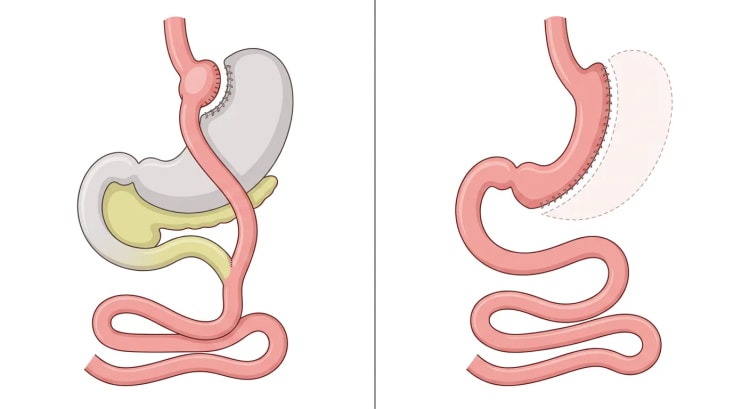 To paneler af mave-tarm-kanalen: til venstre anatomien efter Roux-en-Y gastrisk bypass, til højre efter sleeve-gastrektomi.