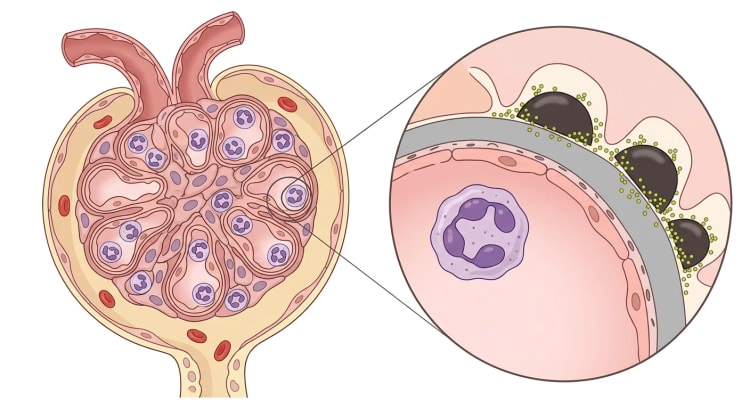 Glomerulus ved poststreptokok-glomerulonefritis med hypercellulært kapillærnøgle og neutrofiler samt forstørret kapillærvæg med subepiteliale immunkompleksaflejringer.