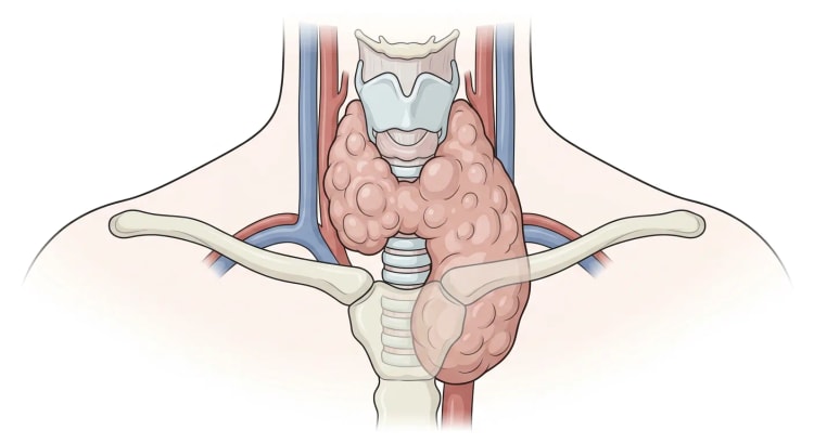 Halsen forfra med en kraftigt og asymmetrisk forstørret, knudret thyreoidea, hvis ene lap når ned bag manubrium og trykker på trachea.