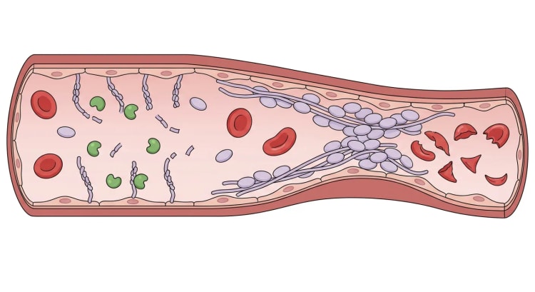 Langsgående gennemskæring af en arteriole. Til venstre spaltes korte von Willebrand-faktorstrenge af ADAMTS13, til højre danner lange uspaltede strenge med bundne trombocytter en mikrotrombe, og nedstrøms ses fragmenterede erytrocytter.