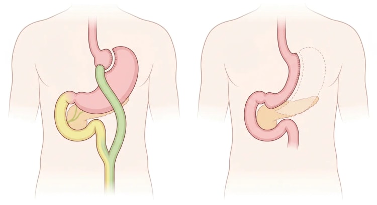 Skematisk anatomi efter Roux-en-Y gastrisk bypass til venstre og sleeve-gastrektomi til højre, set forfra.