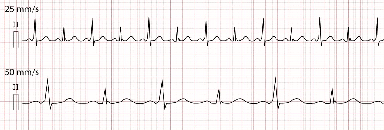 Illustration ur kursen Klinisk EKG-tolkning