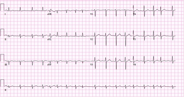 Figur 5. Eksempel på 12-afledningers EKG med atrieflimren. Papirhastighed: 25 mm/s.