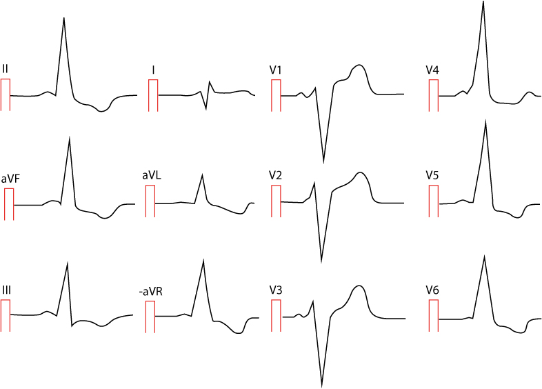 Figur 2. Præeksitation hos en 25-årig kvinde. Der er mange afledninger, der viser ST-segmentdepression og T-bølgeinversion. Der er et meget kort PR-interval, brede QRS-komplekser og deltabølger i mange afledninger. Kan du spotte dem?