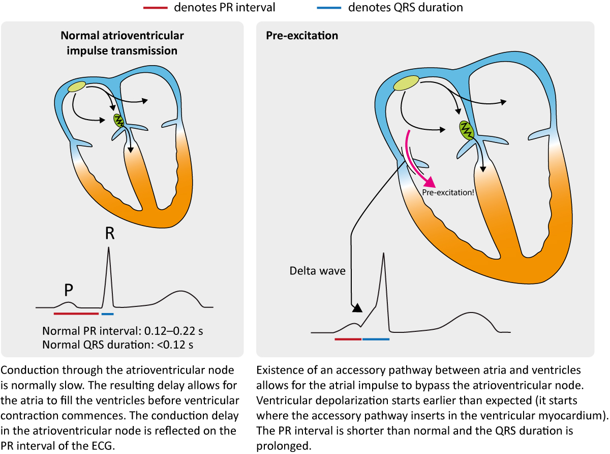 Figur 1. Kendetegnende for præeksitation på EKG.