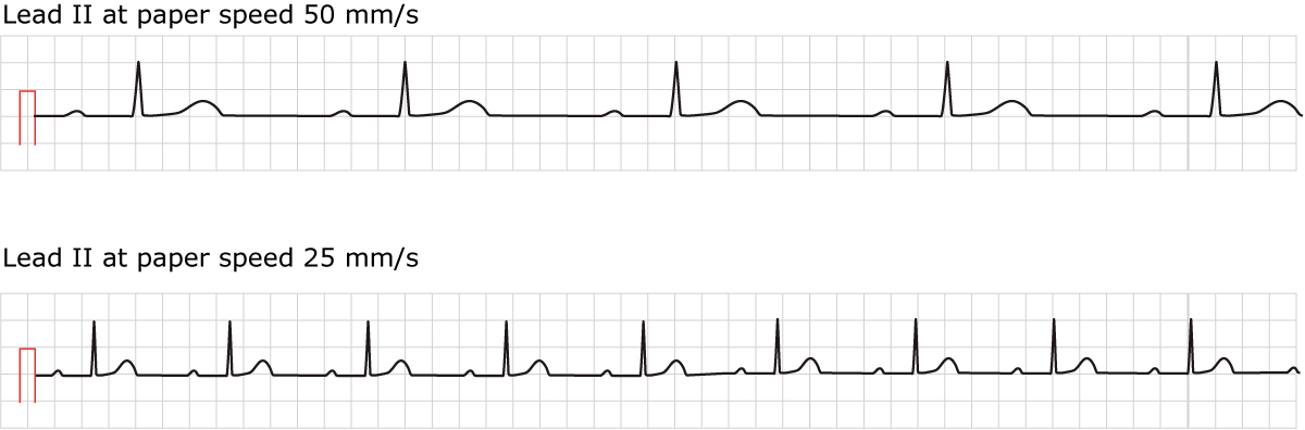 Figur 1. EKG ved førstegrads AV-blok. Begge konventionelle papirhastigheder vises.