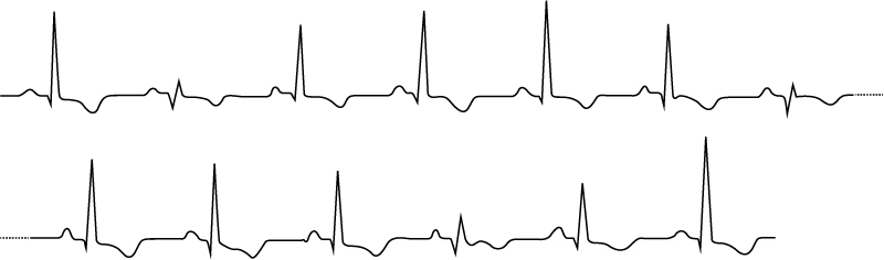 Figur 1. Elektrisk alternans hos en patient med hjertetamponade. EKG'et viser varierende QRS- og T-bølgeamplituder.